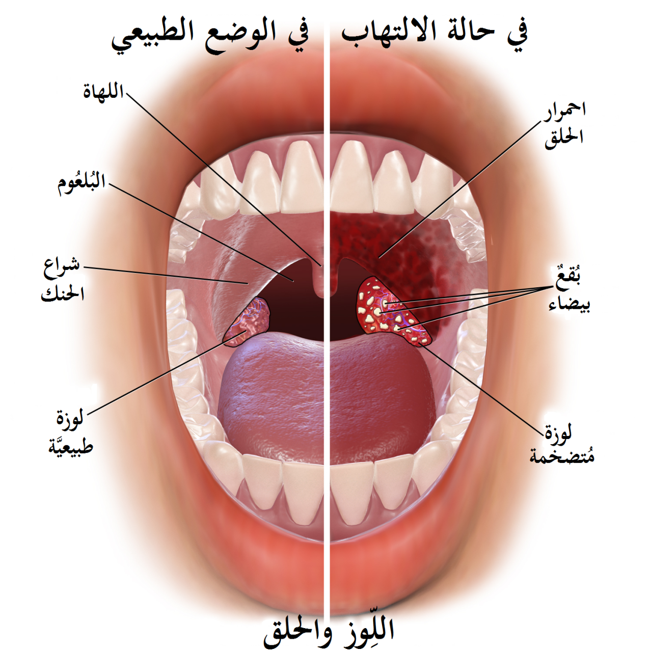 اعراض التهاب اللوزتين الفيروسي , اعرفي اعراض التهاب الحلق واللوزر