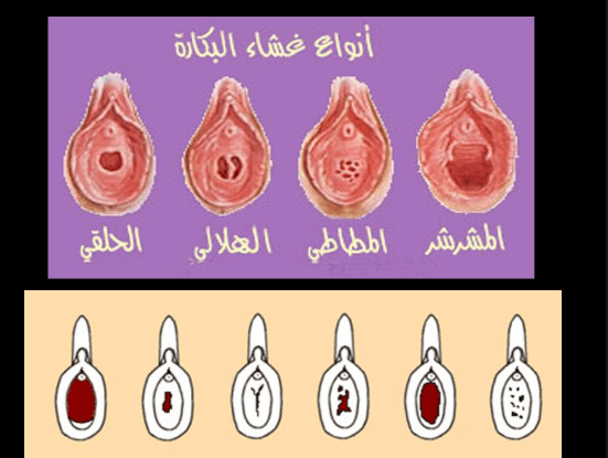 الفرق بين العذراء والغير عذراء بالصور - كيف اعرف اني بنت 3501 1