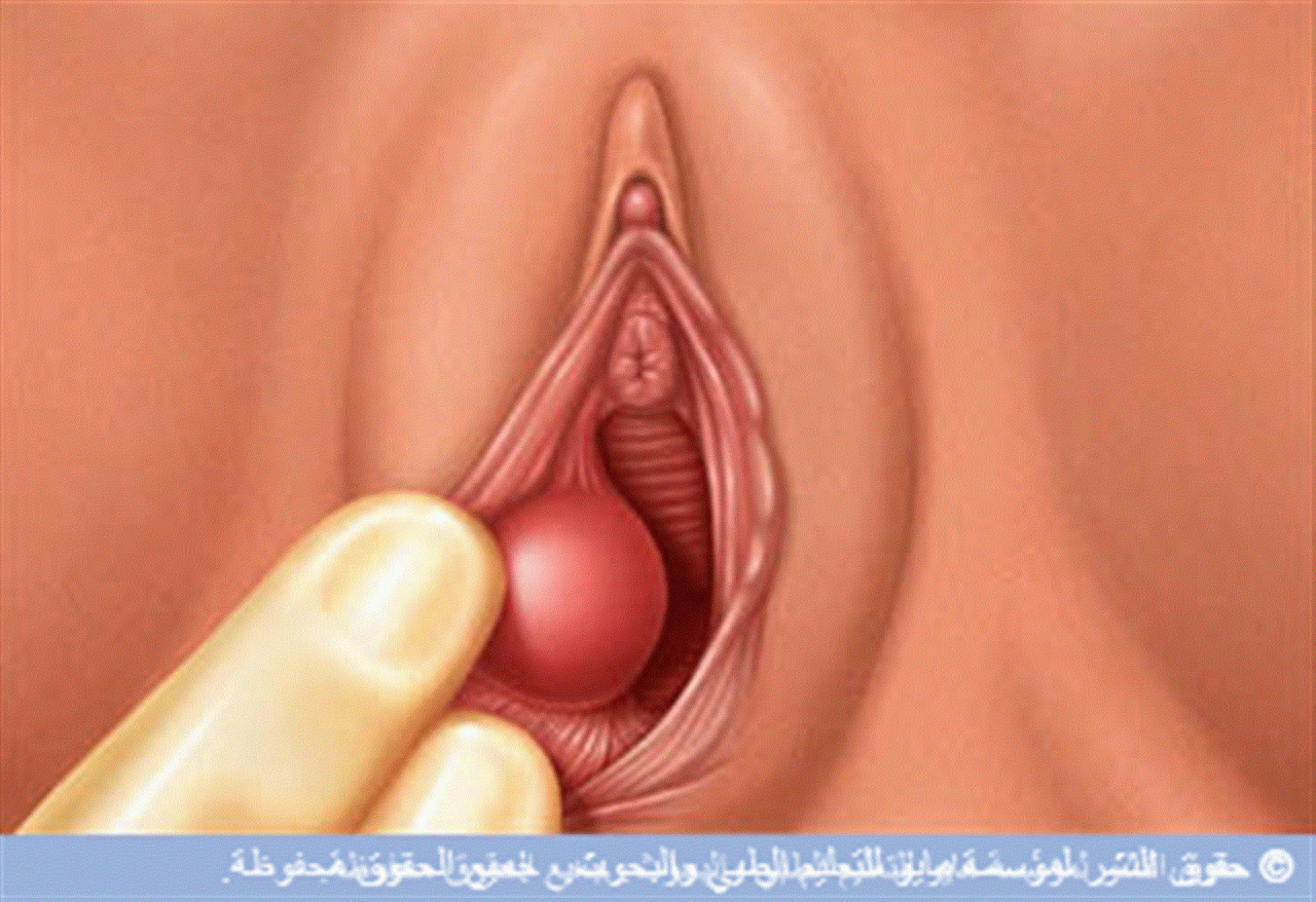 حبه جنب فتحة المهبل - حبوب بغدد بارثولين الاعراض والعلاج 2716