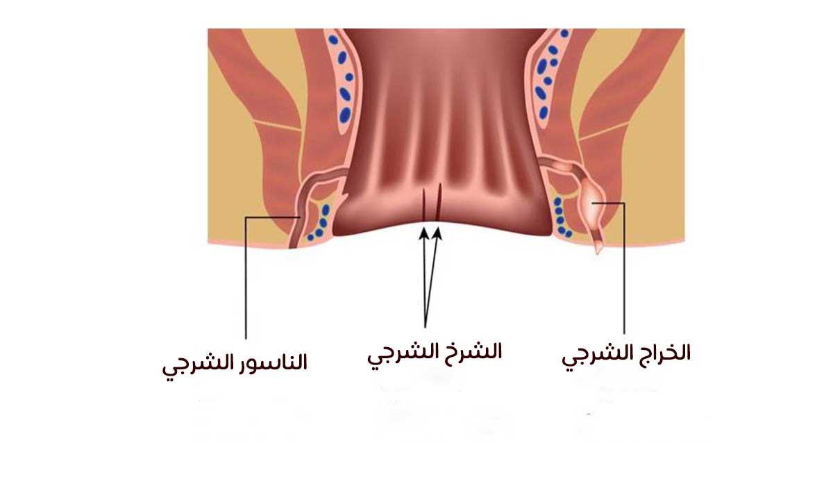 ما هو مرض الناسور , اسباب النسور الشرجي