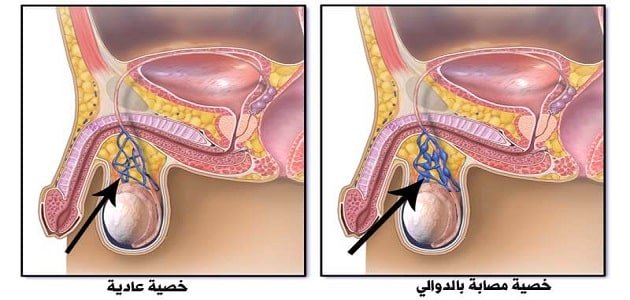 عملية الدوالي في الخصيتين - ما لا تعرفه عن تضخم الاوعيه فى الخصيه 2148