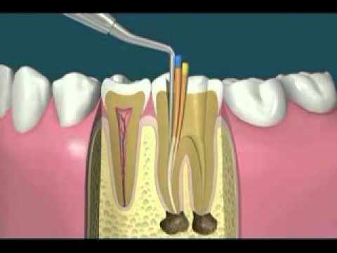 ازالة العصب من الضرس - اضرار كشف العصب و علاجه 2482 1