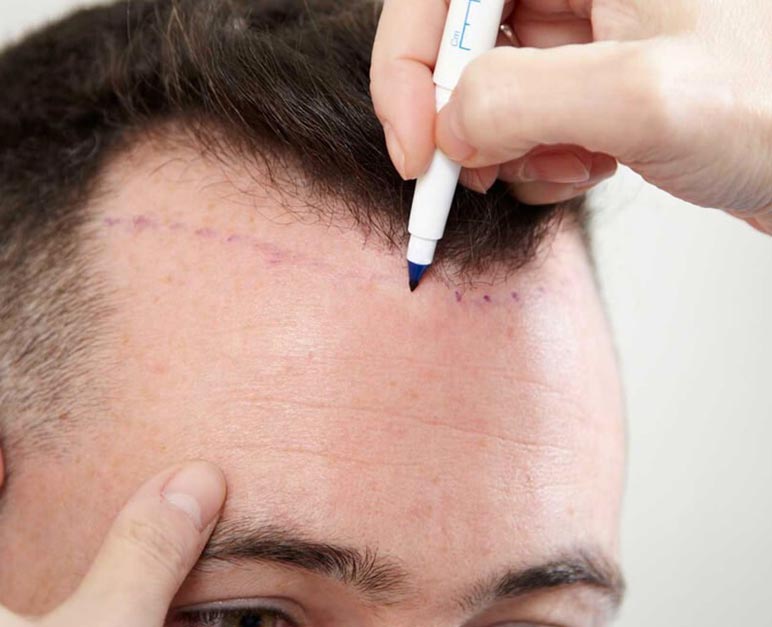 زراعة الشعر في تونس , من اهم التقنيات التي انتشرت في تونس