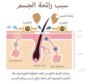 اسباب التعرق الزائد تحت الابط , علاج التعرق الزائد تحت الابط