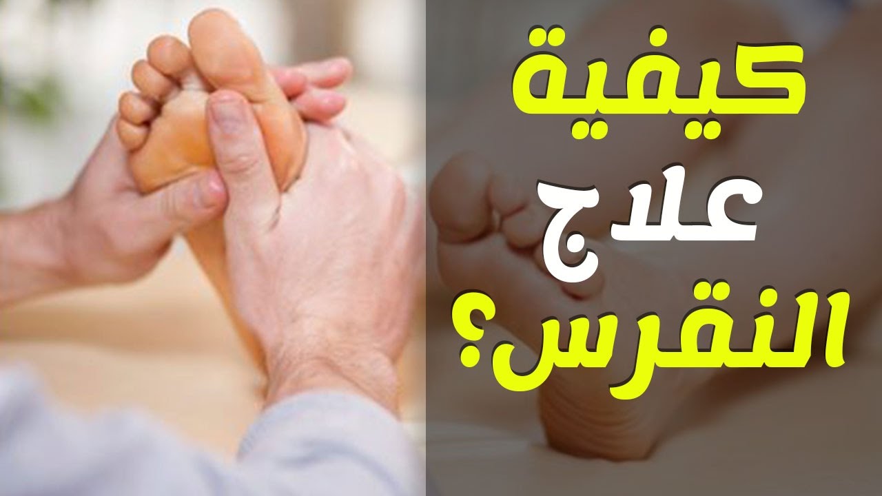 علاج مرض النقرس - ماهو علاج مرض النقرس وطرق الوقاية منه 2065 1