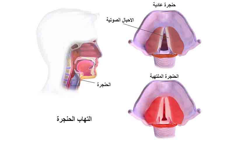 الم في الحنجرة , معلومه لا تعرفها عن التهاب الحنجره