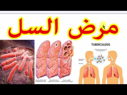 الشفاء من هذا المرض - مرض السل وعلاجه 1302 1