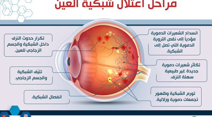 علاج شبكية العين لمرضى السكري بالاعشاب , اعشاب مذهله للحفاظ على العين