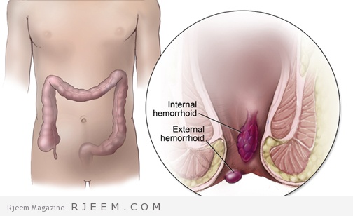 علاج منزلي للبواسير - وصفات مجربة لعلاج البواسير في المنزل 2227 2