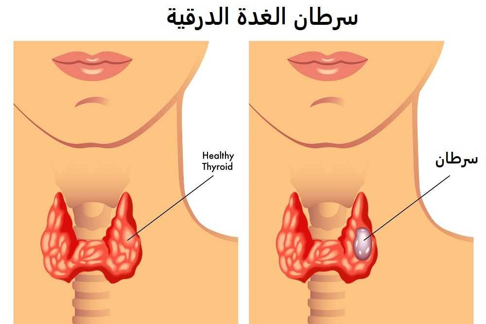 اعراض سرطان الغده الدرقية , تعرفي علي اخطر الانواع