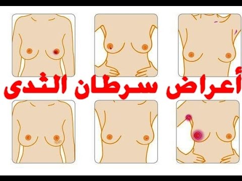 سرطان الثدي عند النساء , اعراض سرطان الثدي لدى النساء