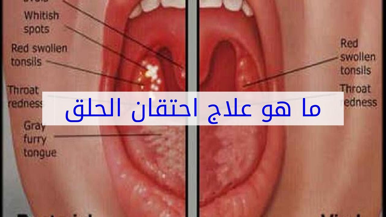 علاج تقرح الحلق والتهابه , افضل طرق علاج التهاب الحلق واللوزتين