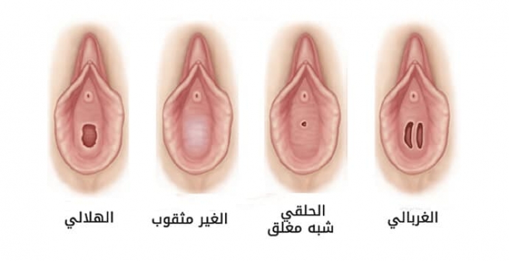 الفرق بين العذراء والغير عذراء بالصور - كيف اعرف اني بنت 3501 7