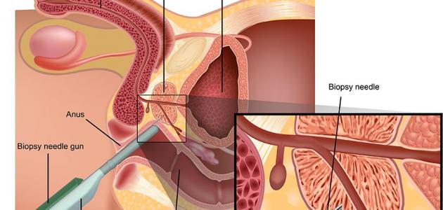 علاج تضخم البروستاتا جابر القحطاني - اسباب و علاج البروستاتا 324 3