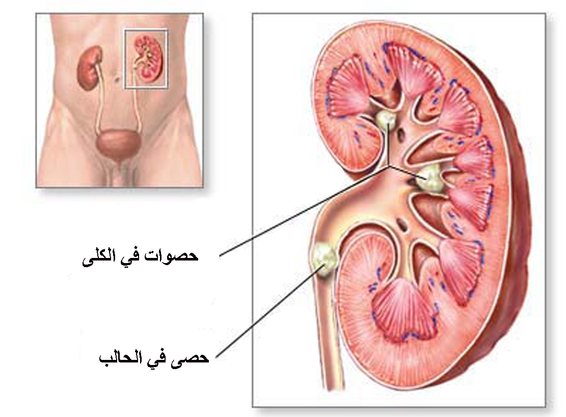 اعراض حصوة الحالب , تعرف علي اعراض حصوه الكلي وطرق تجنبها 