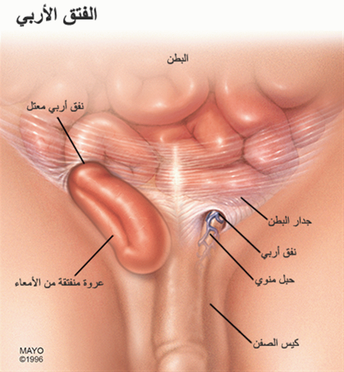 ما هو الفتق في الخصية - اهم الاسباب فى عمل جراحه الفتق فى الخصيه 319 1