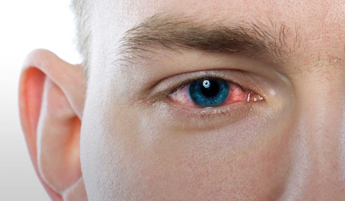 علاج التهاب العين الفيروسي , اسباب و اعراض التهاب العين الفيروسي - ازاي