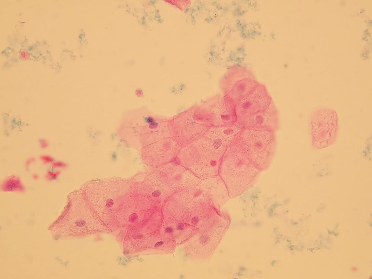 pus cells معنى , اعرف كل شي عن pus cells